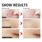 4 Pcs Blackhead Acne Removal Set