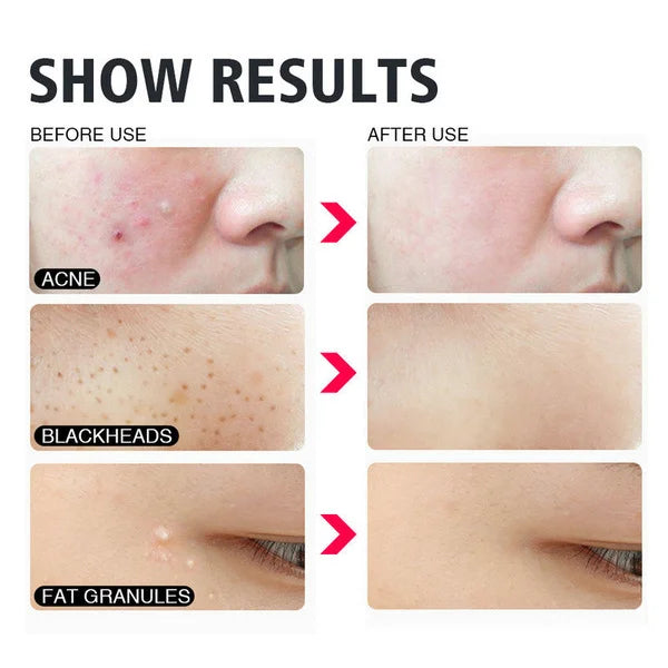 4 Pcs Blackhead Acne Removal Set