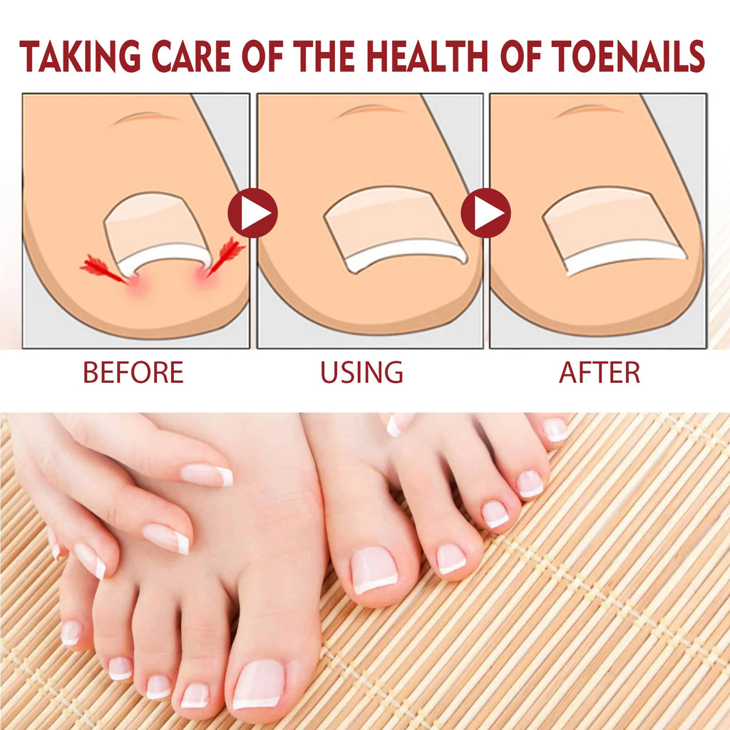 Anti-Fungal Nail Pain Relief Oil