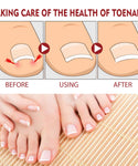 Anti-Fungal Nail Pain Relief Oil
