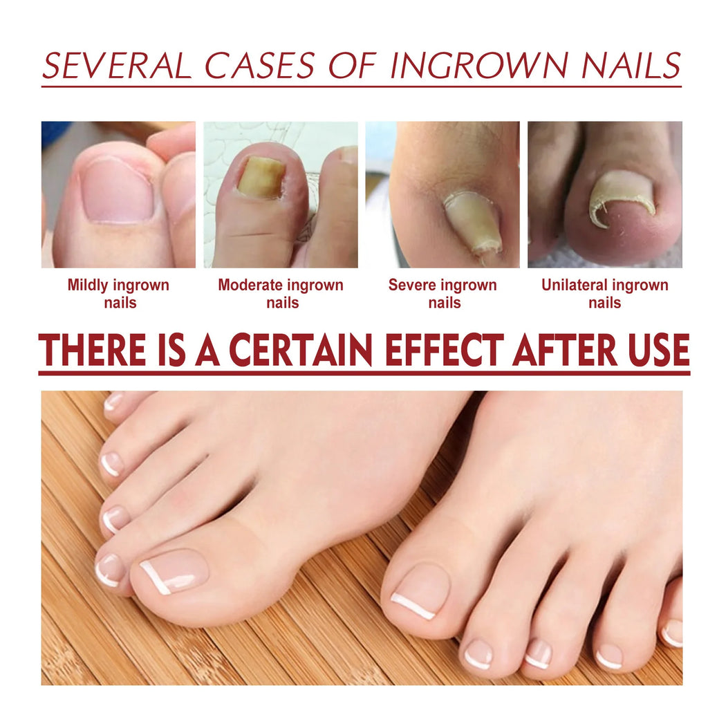 Anti-Fungal Nail Pain Relief Oil