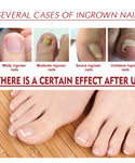 Anti-Fungal Nail Pain Relief Oil