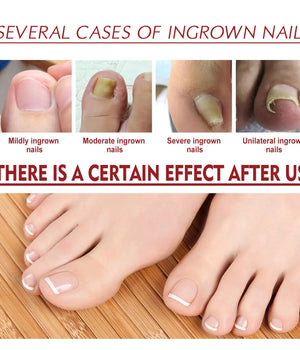 Anti-Fungal Nail Pain Relief Oil