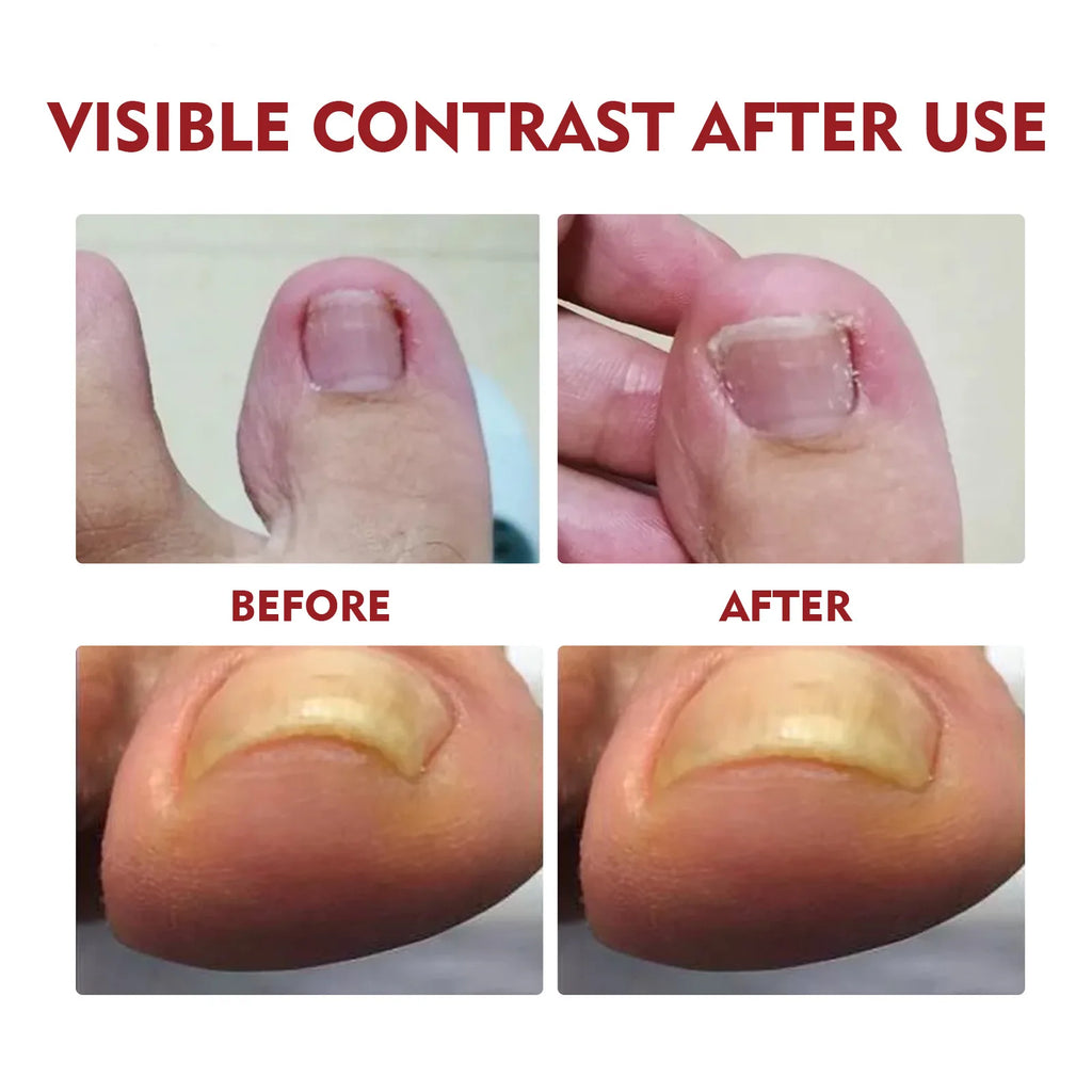 Anti-Fungal Nail Pain Relief Oil