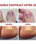 Anti-Fungal Nail Pain Relief Oil